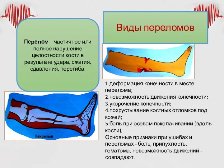 Виды переломов Перелом – частичное или полное нарушение целостности кости