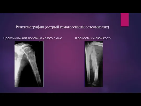 Рентгенография (острый гематогенный остеомиелит) Проксимальная половина левого плеча В области лучевой кости