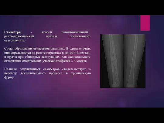 Секвестры - второй патогномоничный рентгенологический признак гематогенного остеомиелита. Сроки образования