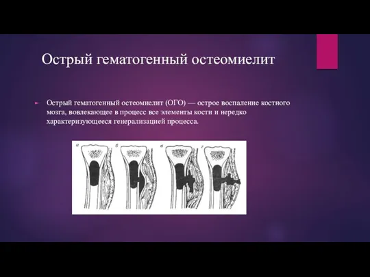 Острый гематогенный остеомиелит Острый гематогенный остеомиелит (ОГО) — острое воспаление