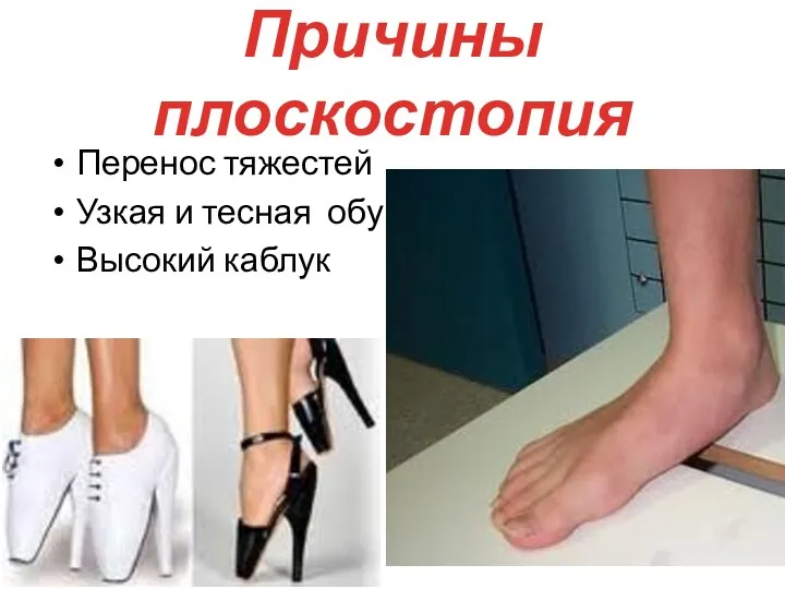 Причины плоскостопия Перенос тяжестей Узкая и тесная обувь Высокий каблук
