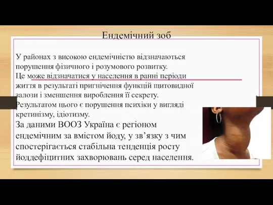 Ендемічний зоб У районах з високою ендемічністю відзначаються порушення фізичного