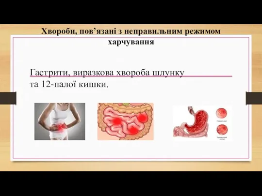 Хвороби, пов’язані з неправильним режимом харчування Гастрити, виразкова хвороба шлунку та 12-палої кишки.