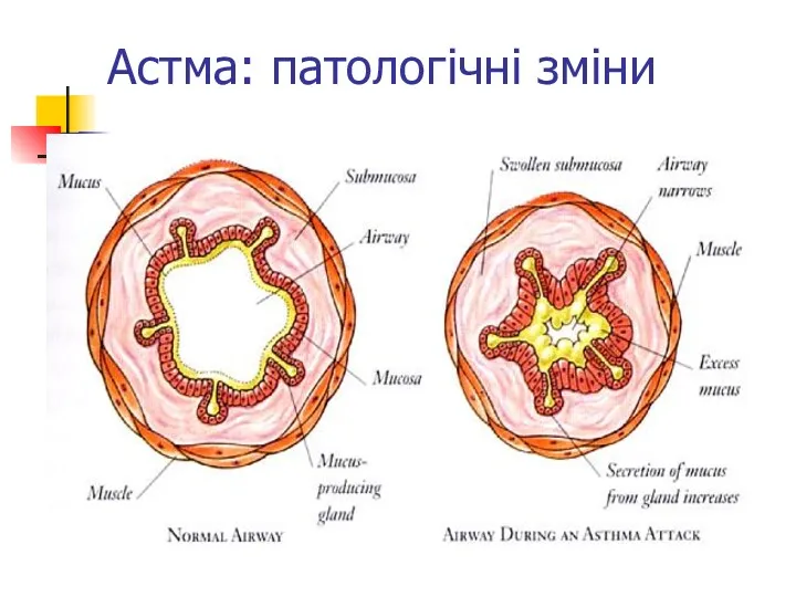 Астма: патологічні зміни