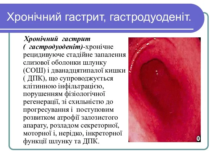 Хронічний гастрит, гастродуоденіт. Хронічний гастрит ( гастродуоденіт)-хронічне рецидивуюче стадійне запалення слизової оболонки шлунку