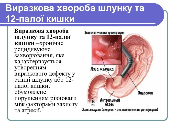 Виразкова хвороба шлунку та 12-палої кишки Виразкова хвороба шлунку та