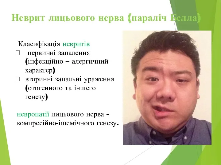 Неврит лицьового нерва (параліч Белла) Класифікація невритів первинні запалення (інфекційно