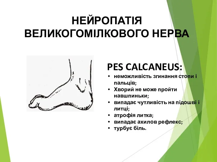 НЕЙРОПАТІЯ ВЕЛИКОГОМІЛКОВОГО НЕРВА PES CALCANEUS: неможливість згинання стопи і пальців;