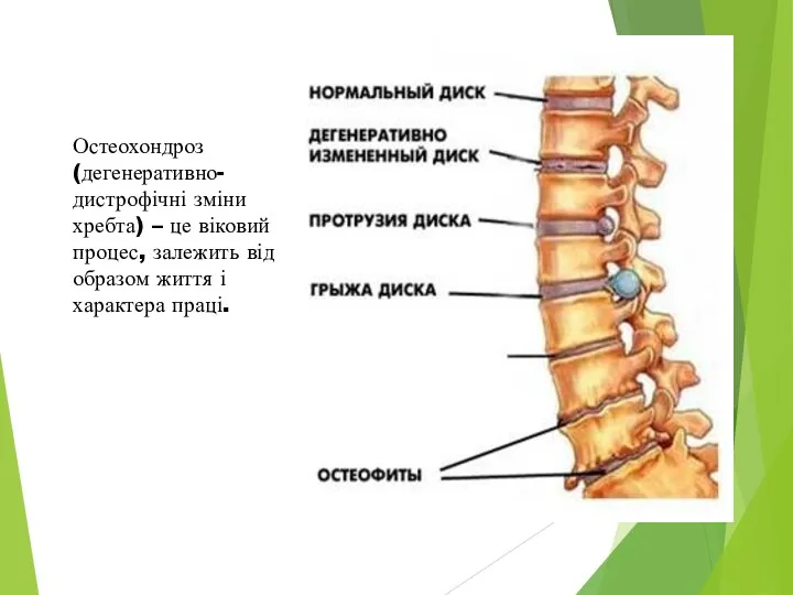 Остеохондроз (дегенеративно-дистрофічні зміни хребта) – це віковий процес, залежить від образом життя і характера праці.