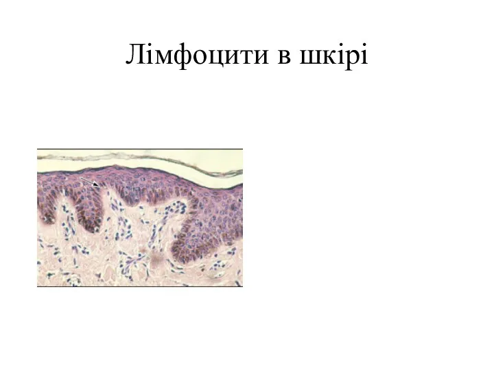 Лімфоцити в шкірі