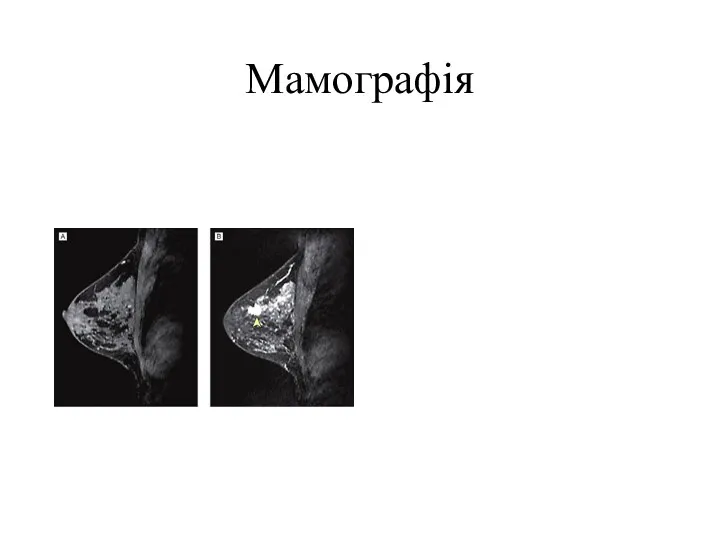 Мамографія