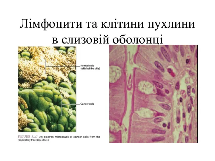 Лімфоцити та клітини пухлини в слизовій оболонці