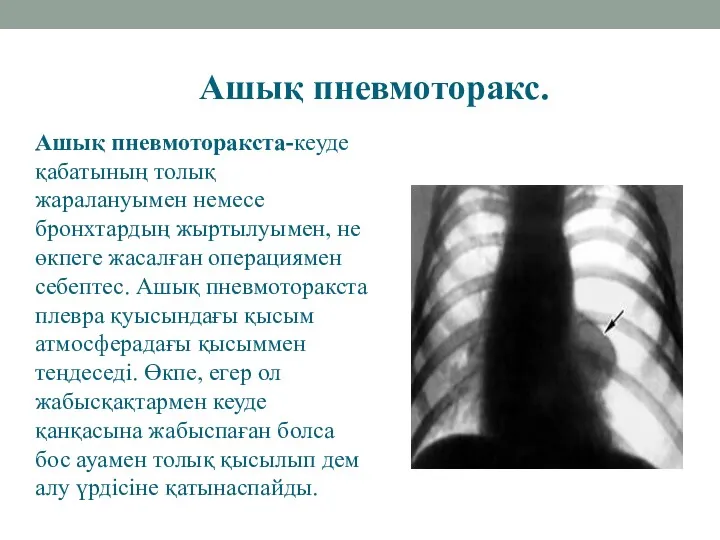 Ашық пневмоторакс. Ашық пневмоторакста-кеуде қабатының толық жаралануымен немесе бронхтардың жыртылуымен,