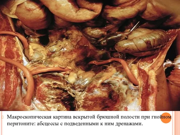 Макроскопическая картина вскрытой брюшной полости при гнойном перитоните: абсцессы с подведенными к ним дренажами.