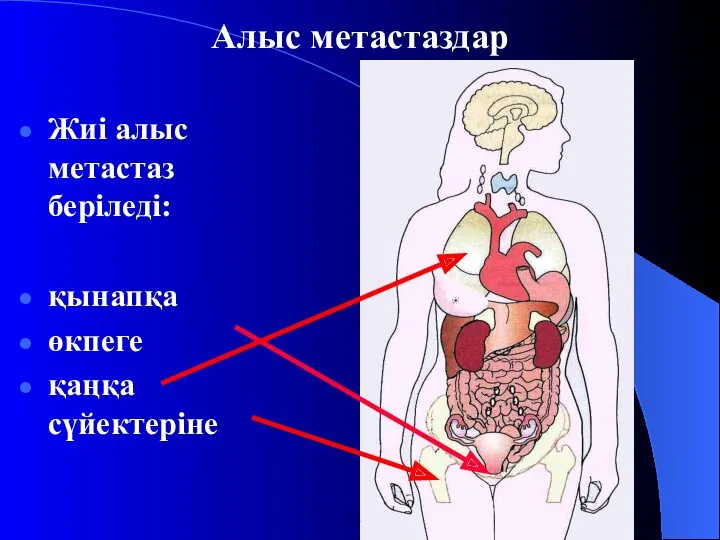 Алыс метастаздар Жиі алыс метастаз беріледі: қынапқа өкпеге қаңқа сүйектеріне