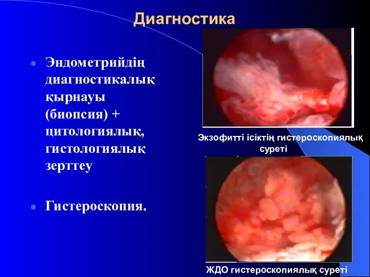 Диагностика Эндометрийдің диагностикалық қырнауы (биопсия) + цитологиялық, гистологиялық зерттеу Гистероскопия.