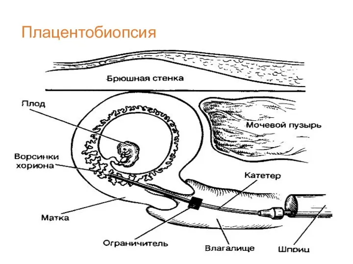 Плацентобиопсия