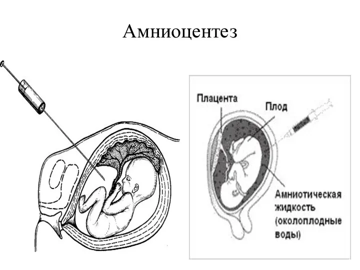 Амниоцентез