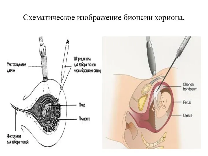 Схематическое изображение биопсии хориона.