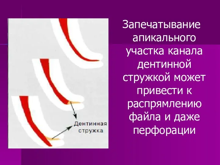 Запечатывание апикального участка канала дентинной стружкой может привести к распрямлению файла и даже перфорации