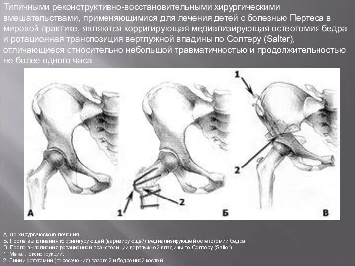 Типичными реконструктивно-восстановительными хирургическими вмешательствами, применяющимися для лечения детей с болезнью