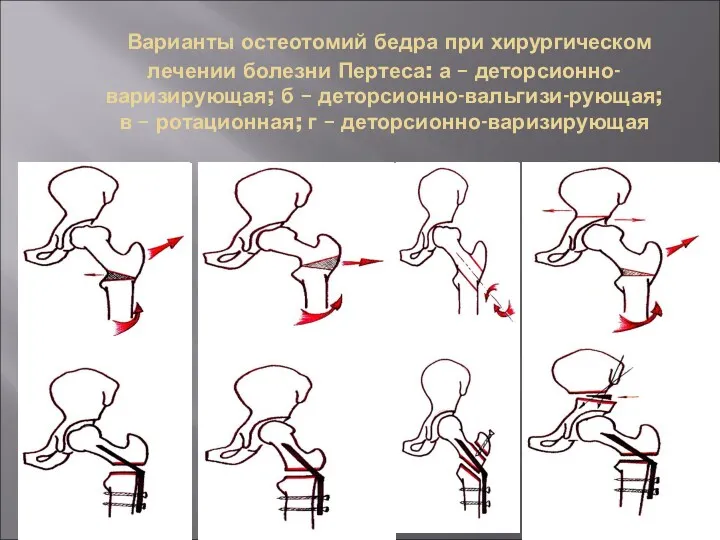 Варианты остеотомий бедра при хирургическом лечении болезни Пертеса: а –