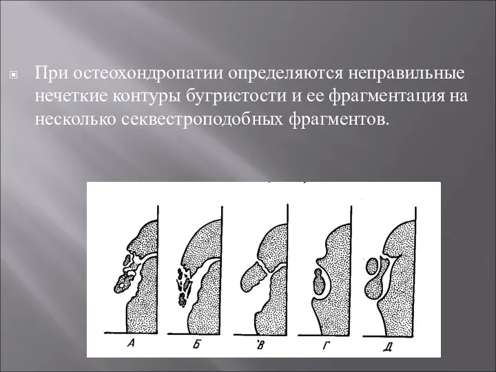 При остеохондропатии определяются неправильные нечеткие контуры бугристости и ее фрагментация на несколько секвестроподобных фрагментов.