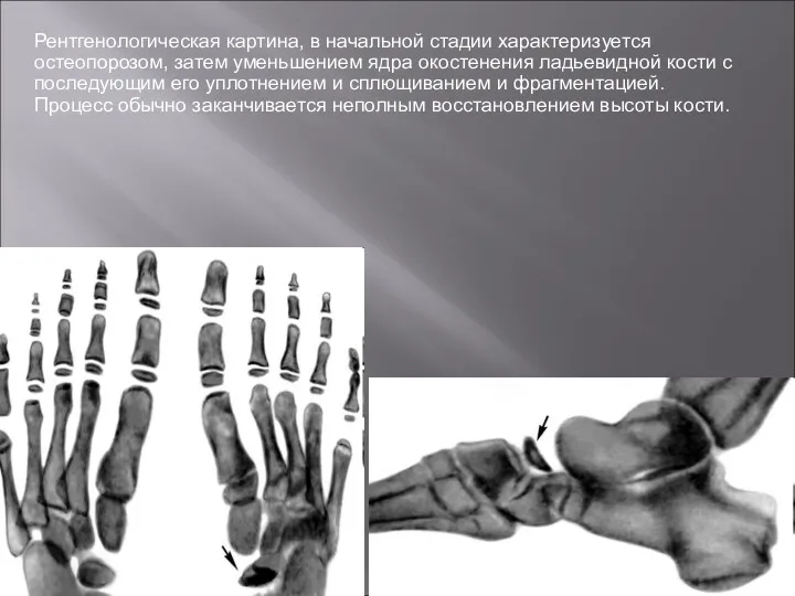 Рентгенологическая картина, в начальной стадии характеризуется остеопорозом, затем уменьшением ядра