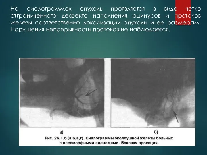 На сиалограммах опухоль проявляется в виде четко отграниченного дефекта наполнения