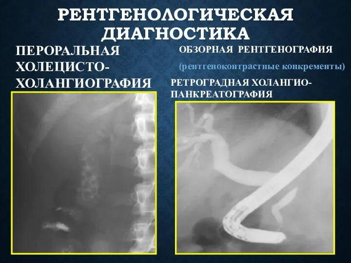 РЕНТГЕНОЛОГИЧЕСКАЯ ДИАГНОСТИКА ОБЗОРНАЯ РЕНТГЕНОГРАФИЯ (рентгеноконтрастные конкременты) ПЕРОРАЛЬНАЯ ХОЛЕЦИСТО-ХОЛАНГИОГРАФИЯ РЕТРОГРАДНАЯ ХОЛАНГИО-ПАНКРЕАТОГРАФИЯ