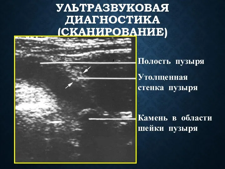 УЛЬТРАЗВУКОВАЯ ДИАГНОСТИКА (СКАНИРОВАНИЕ) Полость пузыря Утолщенная стенка пузыря Камень в области шейки пузыря