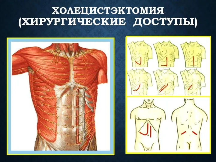 ХОЛЕЦИСТЭКТОМИЯ (ХИРУРГИЧЕСКИЕ ДОСТУПЫ)