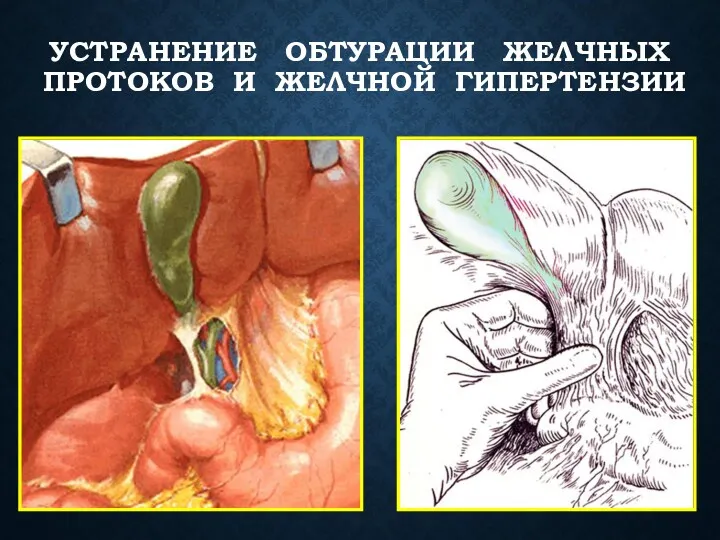 УСТРАНЕНИЕ ОБТУРАЦИИ ЖЕЛЧНЫХ ПРОТОКОВ И ЖЕЛЧНОЙ ГИПЕРТЕНЗИИ