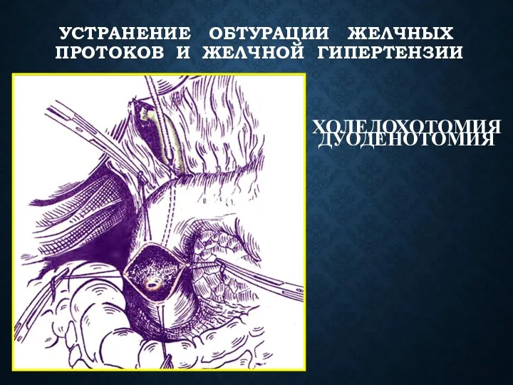 ХОЛЕДОХОТОМИЯ УСТРАНЕНИЕ ОБТУРАЦИИ ЖЕЛЧНЫХ ПРОТОКОВ И ЖЕЛЧНОЙ ГИПЕРТЕНЗИИ ДУОДЕНОТОМИЯ