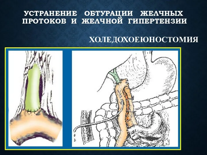 ХОЛЕДОХОЕЮНОСТОМИЯ УСТРАНЕНИЕ ОБТУРАЦИИ ЖЕЛЧНЫХ ПРОТОКОВ И ЖЕЛЧНОЙ ГИПЕРТЕНЗИИ