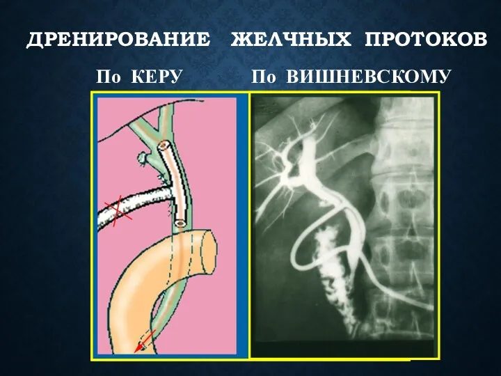 ДРЕНИРОВАНИЕ ЖЕЛЧНЫХ ПРОТОКОВ По КЕРУ По ВИШНЕВСКОМУ