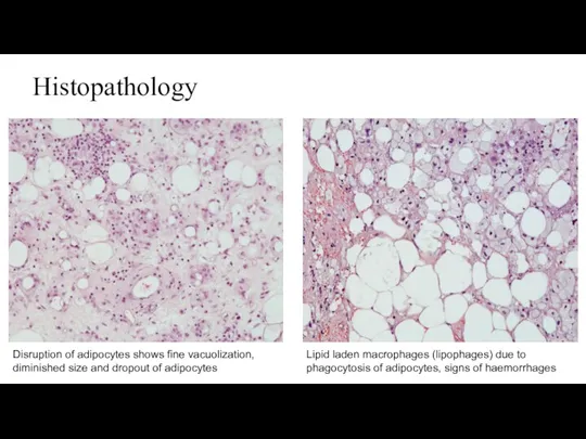 Histopathology Lipid laden macrophages (lipophages) due to phagocytosis of adipocytes,