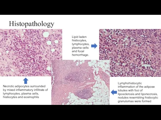 Histopathology Necrotic adipocytes surrounded by mixed inflammatory infiltrate of lymphocytes,