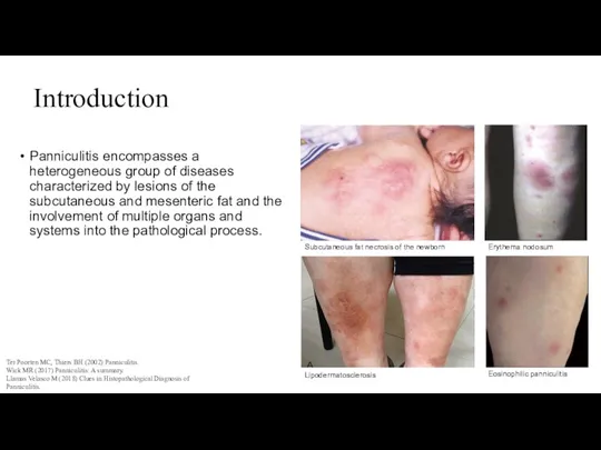 Introduction Panniculitis encompasses a heterogeneous group of diseases characterized by