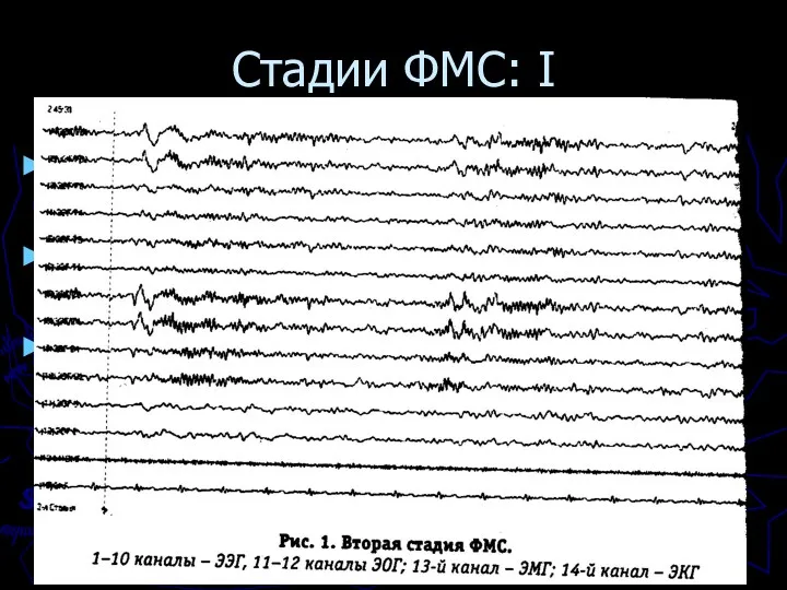 Стадии ФМС: I Стадия сна I = дремота = гипнотическое