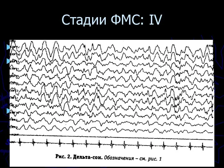 Стадии ФМС: IV Стадия IV = глубокий сон Увеличение числа