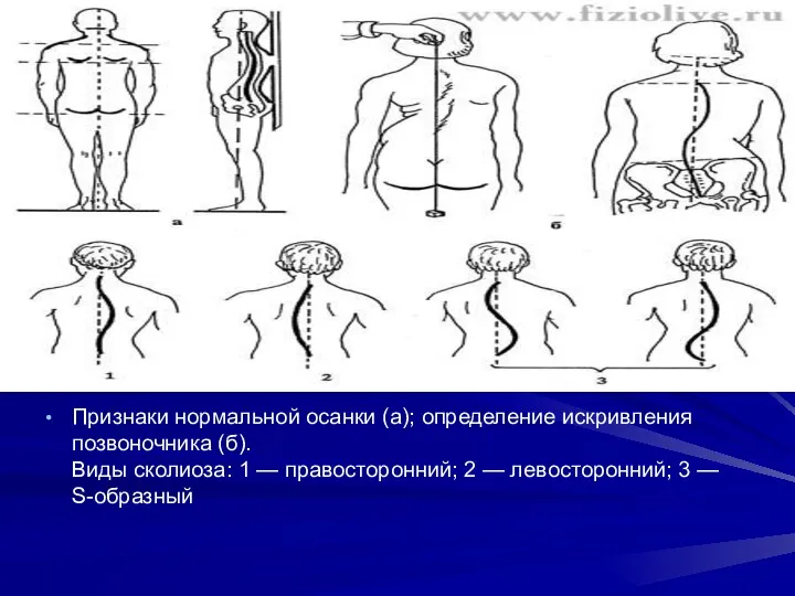 Признаки нормальной осанки (а); определение искривления позвоночника (б). Виды сколиоза: