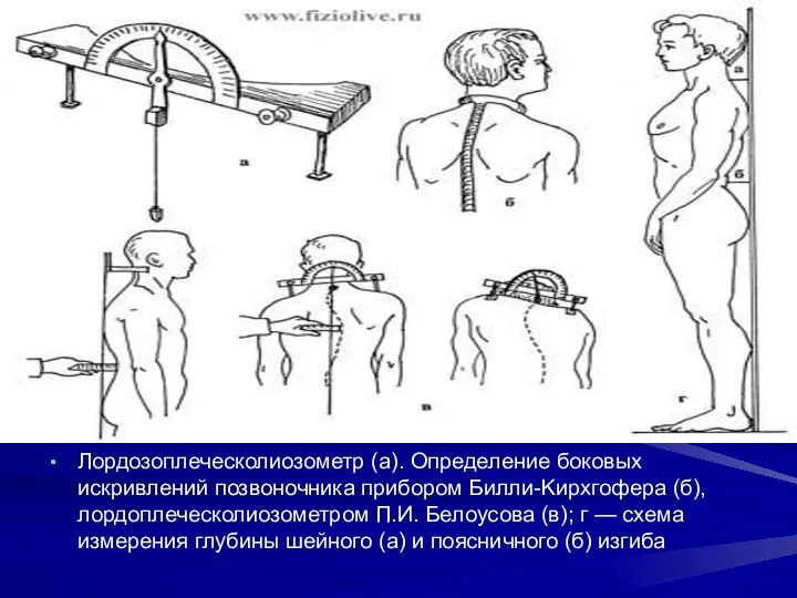 Лордозоплеческолиозометр (а). Определение боковых искривлений позвоночника прибором Билли-Kирхгофера (б), лордоплеческолиозометром