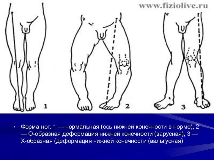 Форма ног: 1 — нормальная (ось нижней конечности в норме);
