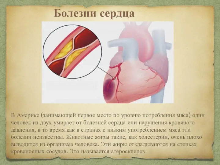 Болезни сердца В Америке (занимающей первое место по уровню потребления