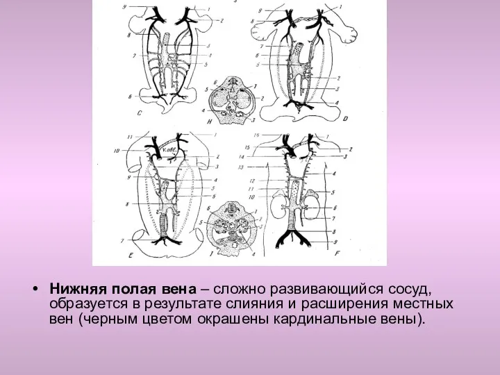 Нижняя полая вена – сложно развивающийся сосуд, образуется в результате