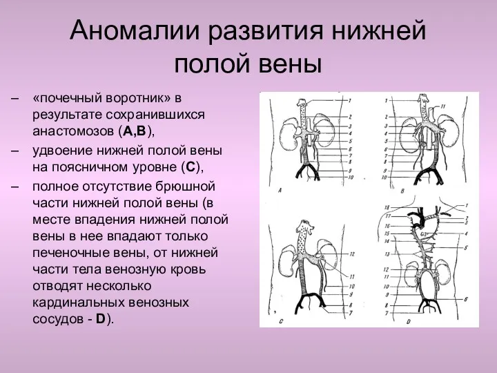 Аномалии развития нижней полой вены «почечный воротник» в результате сохранившихся