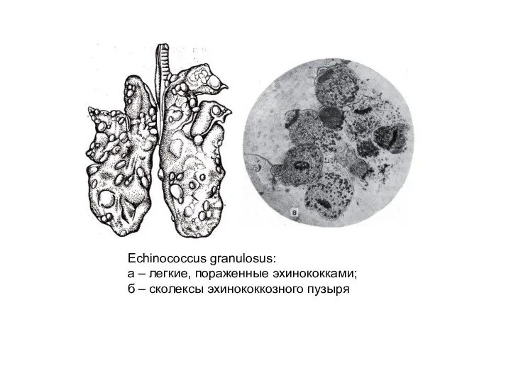 Echinococcus granulosus: а – легкие, пораженные эхинококками; б – сколексы эхинококкозного пузыря