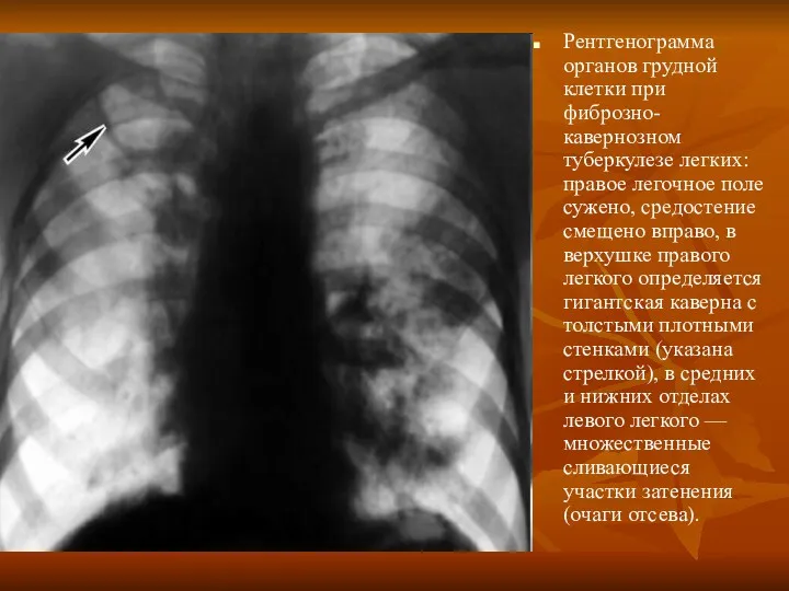 Рентгенограмма органов грудной клетки при фиброзно-кавернозном туберкулезе легких: правое легочное