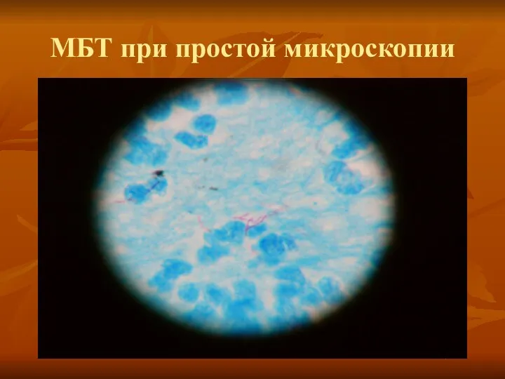 МБТ при простой микроскопии